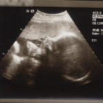 32 week ultrasound