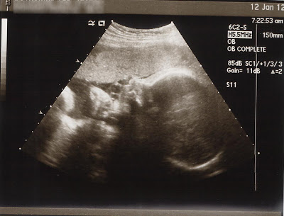 32 week ultrasound