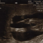 15 week ultrasound