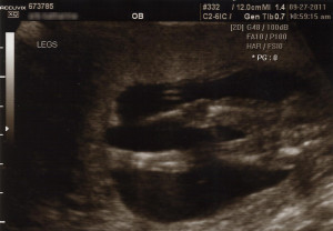 15 week ultrasound