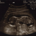 15 week ultrasound