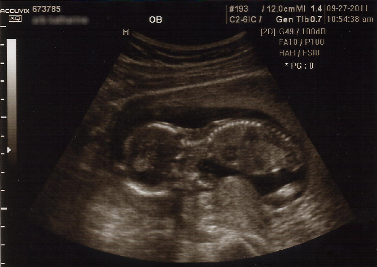 15 week ultrasound