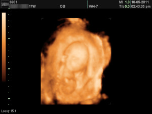 17 week ultrasound