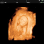 17 week ultrasound