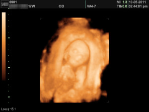 17 week ultrasound