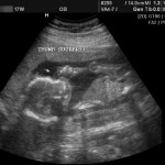 17 week ultrasound