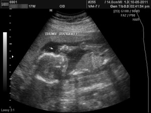 17 week ultrasound