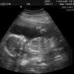 17 Week Ultrasound Photos