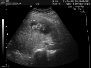 17 week ultrasound