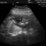 17 week ultrasound