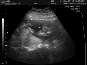 17 week ultrasound