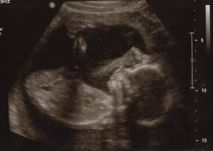 20 week ultrasound