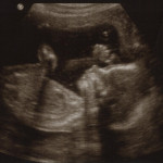 20 week ultrasound