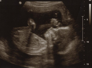 20 week ultrasound