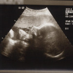 Isla at 32 Weeks