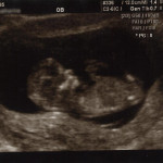 11 Week Ultrasound