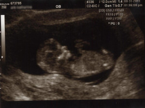 11 week ultrasound