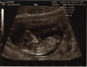 11 week ultrasound