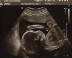 Isla - 24 week ultrasound