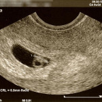 Baking #2: 6 Week Ultrasound