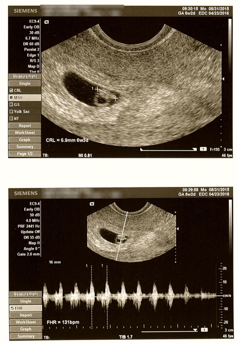 6w3d ultrasound