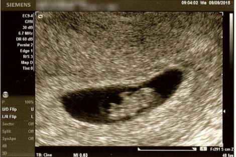 7w5d ultrasound