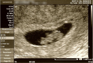 7w5d ultrasound