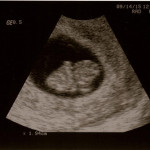 Baking #2: 8 Week Ultrasound