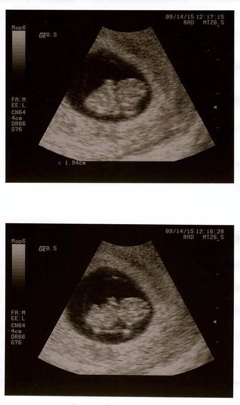 8w3d ultrasound