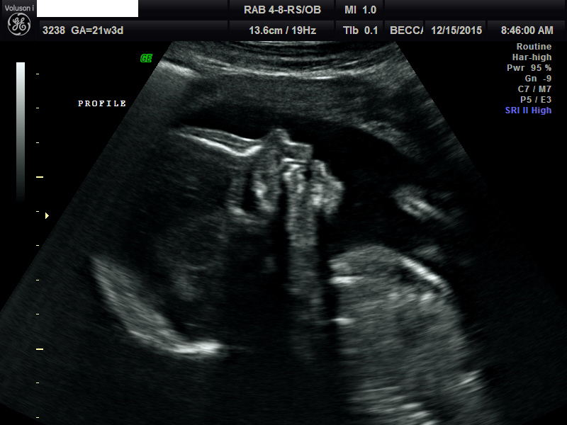 Baby Boy at 21 Weeks