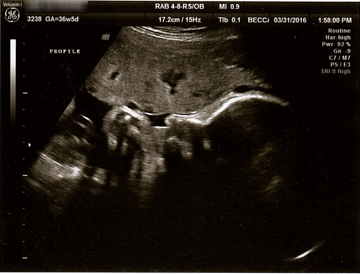 Baby boy at 36 weeks