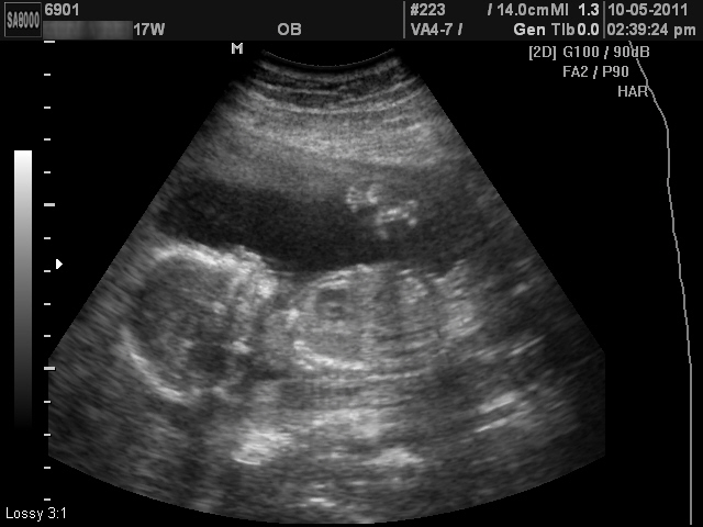 17 Week Ultrasound Photos