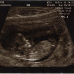 11 week ultrasound