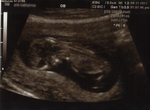 11 week ultrasound