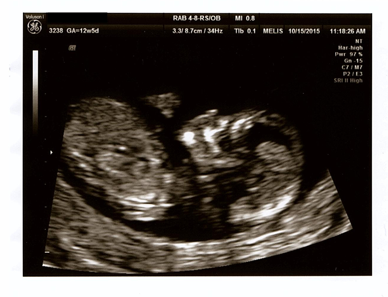 12 Week Ultrasound